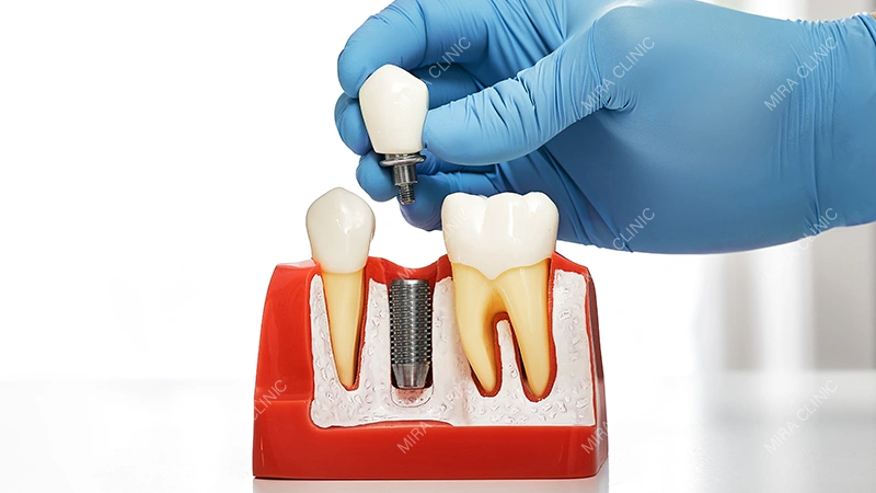 Dental Implants